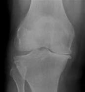 Osteoarthritis_of_knee